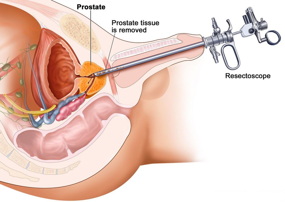 Accurate Diagnosis of Prostatitis by Collection of Prostate Tissue
