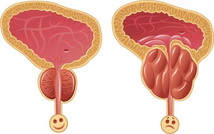 Healthy prostatitis and prostatitis